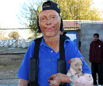 Burn Victim at shelter